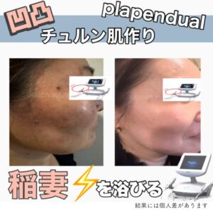 最新プラズママシンでのシミケア症例