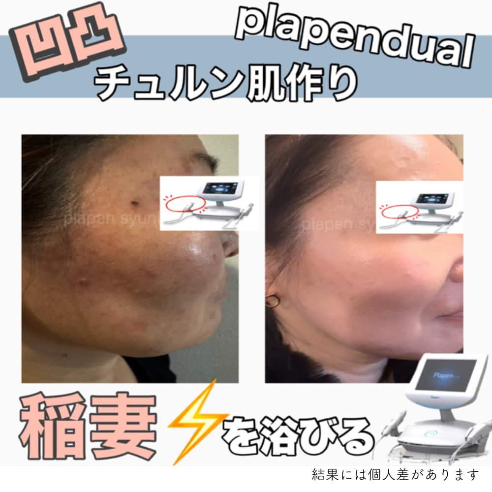 最新プラズママシンでのシミケア症例