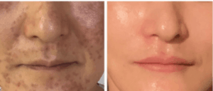 クリニックでの炎症後色素沈着の改善例