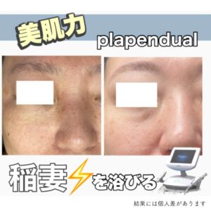 最新プラズママシンでのシミケア症例