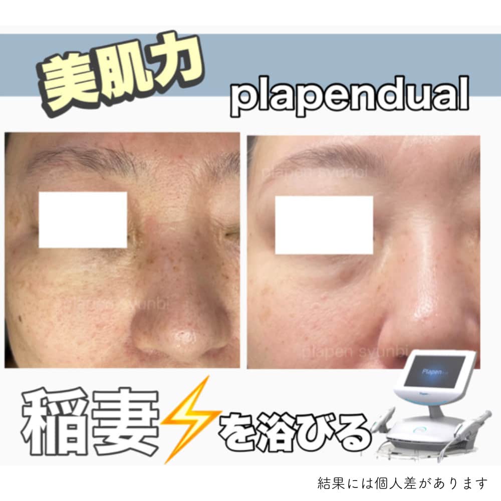 最新プラズママシンでのシミケア症例