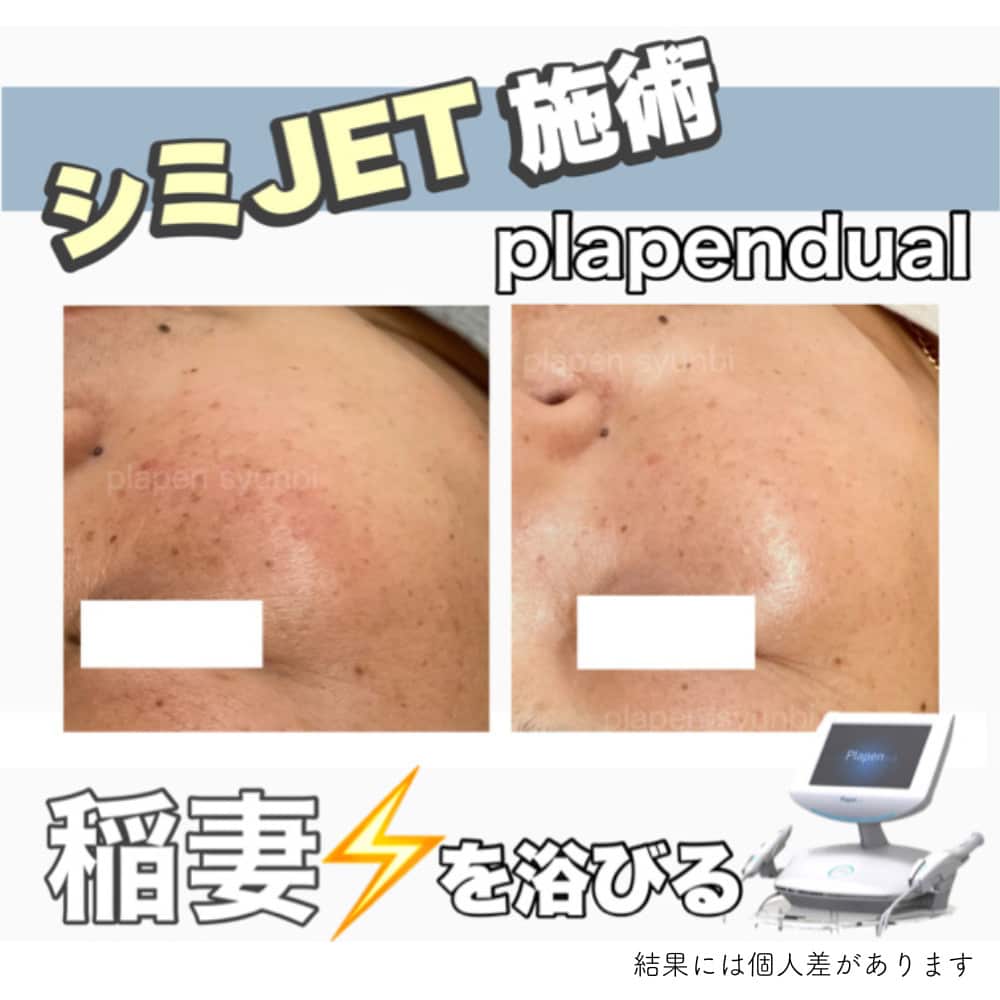 最新プラズママシンでのシミケア症例