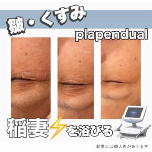 最新プラズママシンでのシミケア症例