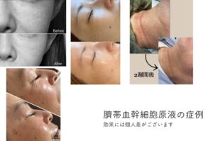 最新プラズママシンでのシミケア症例