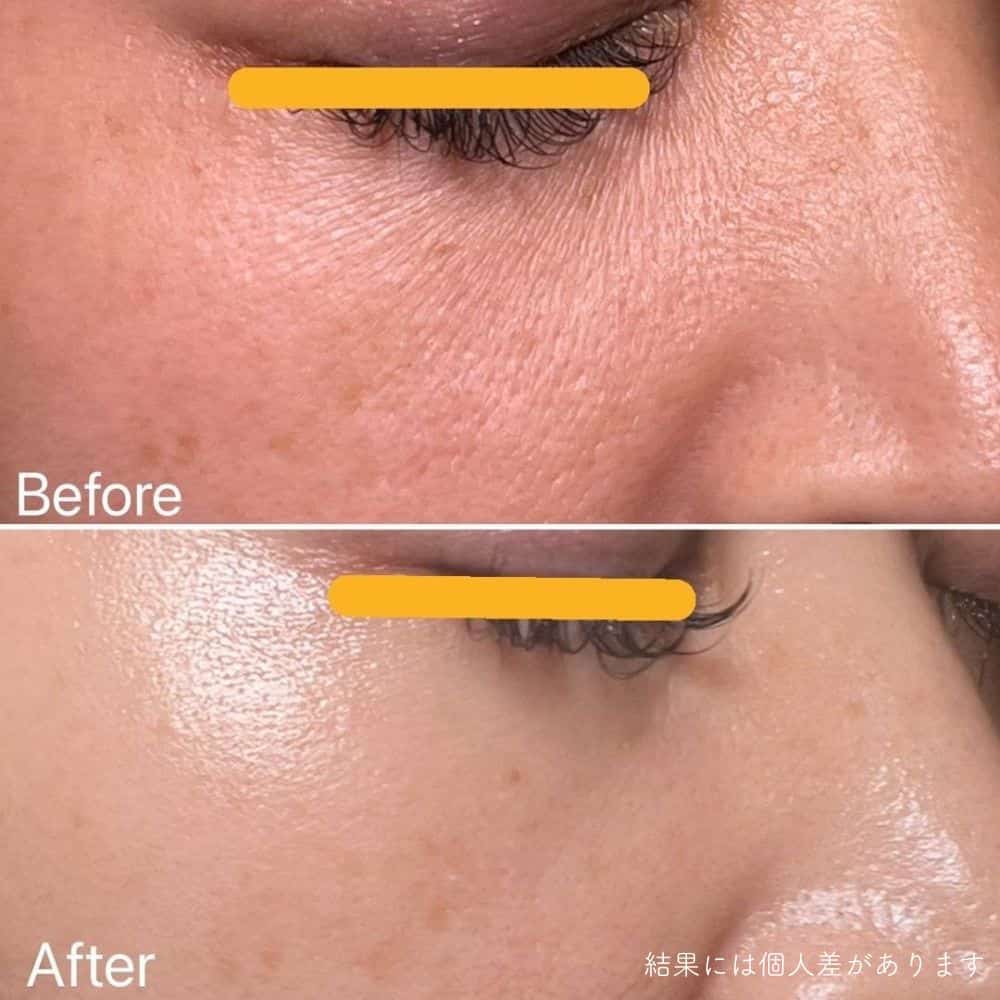 幹細胞フェイシャル　シミ・しわ・たるみの若返りに効果的