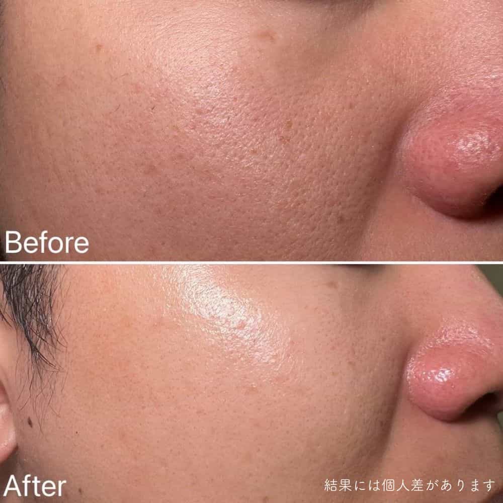 幹細胞フェイシャル症例