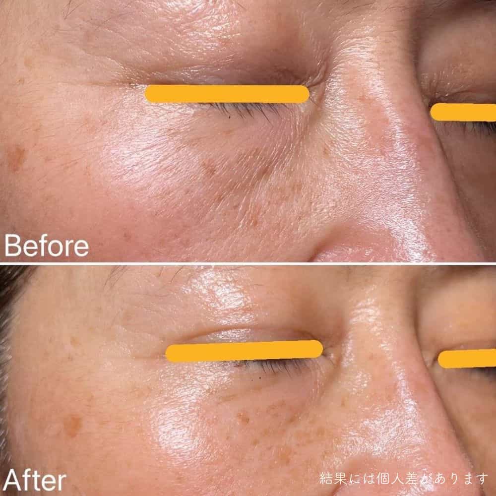 幹細胞フェイシャル症例