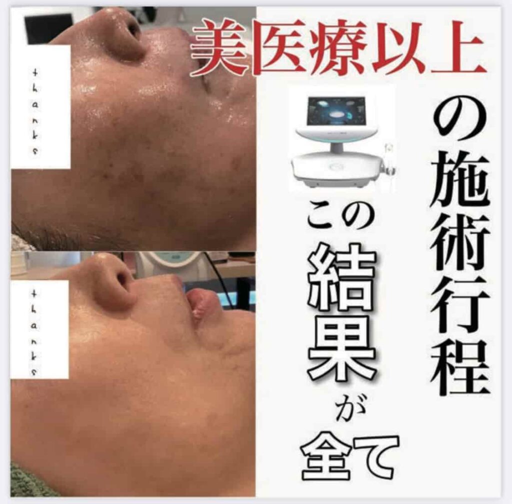 美容医療以上のシミ施術