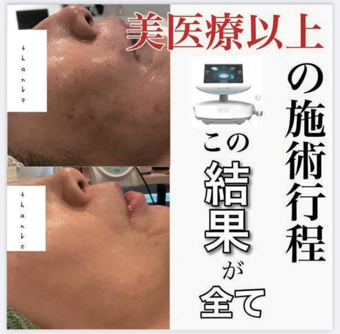 最新プラズマシミ施術